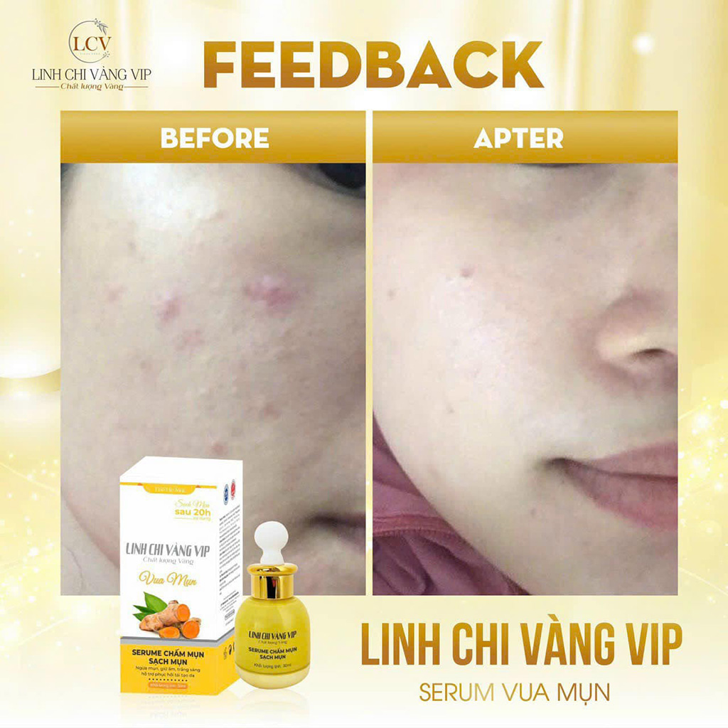 Serum Chấm Mụn Siêu Tốc 20H Linh Chi Vàng 30ml - Bí Quyết Đánh Bay Mụn Trong 20 Giờ