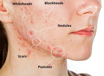 Trị mụn tuổi dậy thì, nguyên nhân và giải pháp