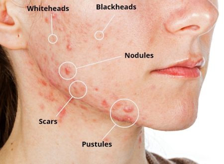 Trị mụn tuổi dậy thì, nguyên nhân và giải pháp