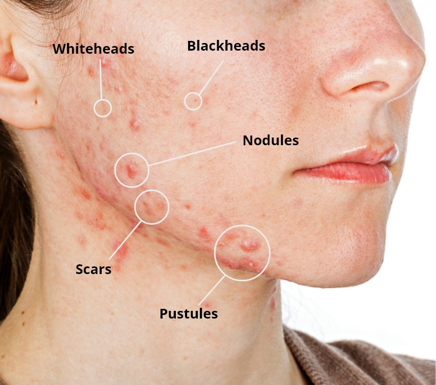 Trị mụn tuổi dậy thì, nguyên nhân và giải pháp