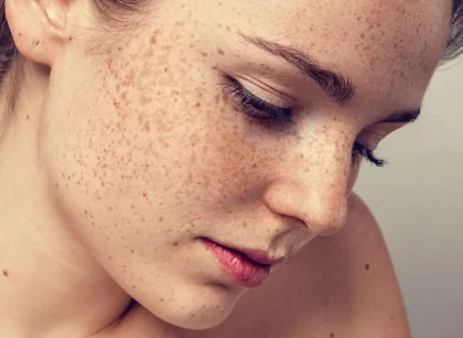 Bị Nám, Chúng Ta Có Nên Sử Dụng Kem Trị Nám Không?