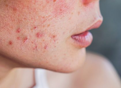 Tìm hiểu các loại kem trị mụn hiệu quả nhất hiện nay