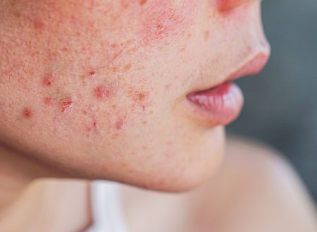 Tìm hiểu các loại kem trị mụn hiệu quả nhất hiện nay