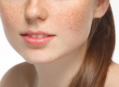 Hướng dẫn cách điều trị nám hiệu quả tại nhà