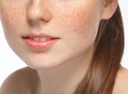 Hướng dẫn cách điều trị nám hiệu quả tại nhà