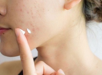 Kem trị mụn – Giải pháp chăm sóc da hiệu quả