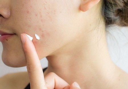 Kem trị mụn – Giải pháp chăm sóc da hiệu quả