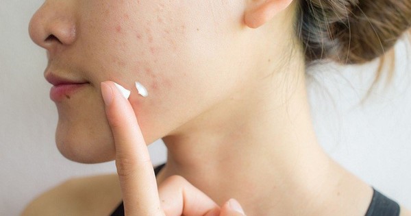 Kem trị mụn - Giải pháp chăm sóc da hiệu quả