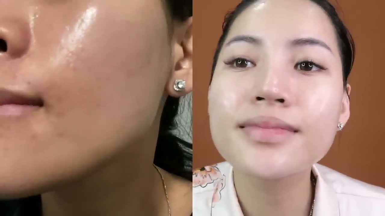 Kem trị mụn - Giải pháp chăm sóc da hiệu quả