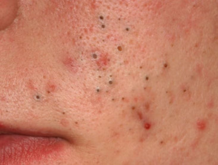 Mụn trứng cá Nguyên nhân, cách điều trị và phòng ngừa hiệu quả