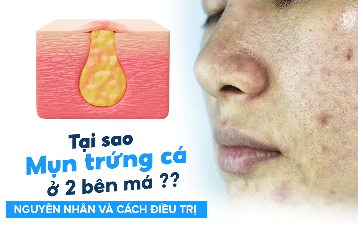 Mụn trứng cá Nguyên nhân, cách điều trị và phòng ngừa hiệu quả